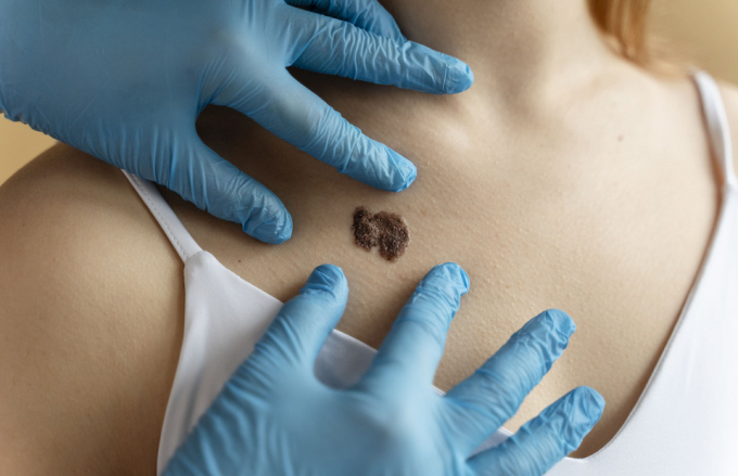 Родимки на тілі, які потрібно терміново показати лікарю