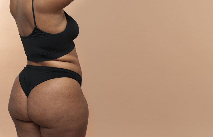 Целюліт: генетика чи лінощі? Думка лікарів