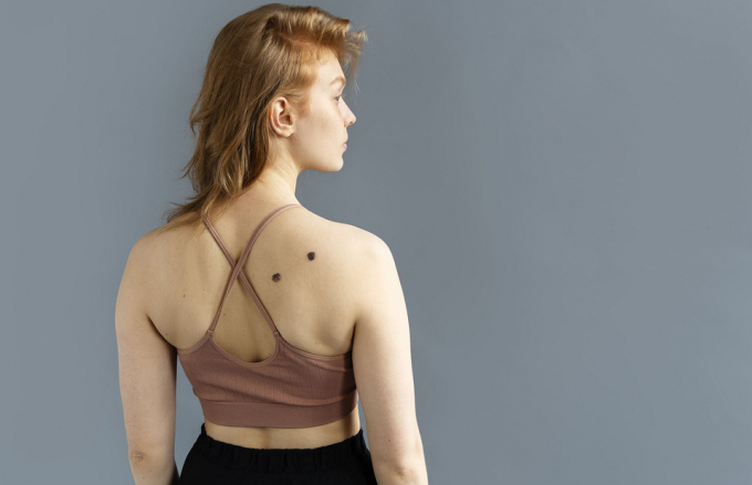 Родимки на тілі, які потрібно терміново показати лікарю