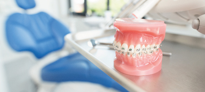 Брекети для гарної посмішки та здоров’я зубів