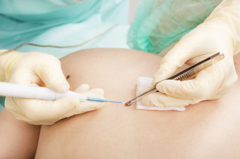 Удаление новообразований в центре "Лазерсвiт"