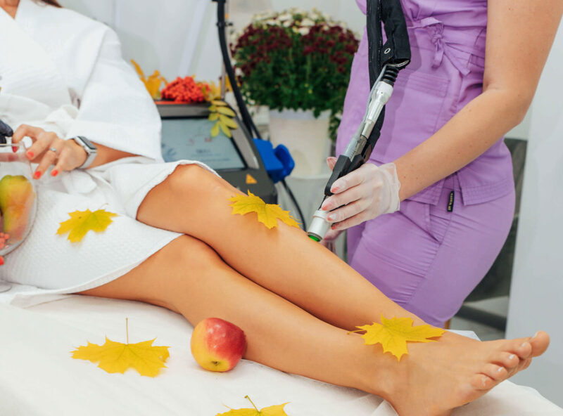 Лазерная эпиляция