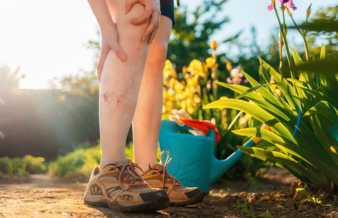 Судинні зірочки: естетичний дефект або перша ознака серйозної хвороби