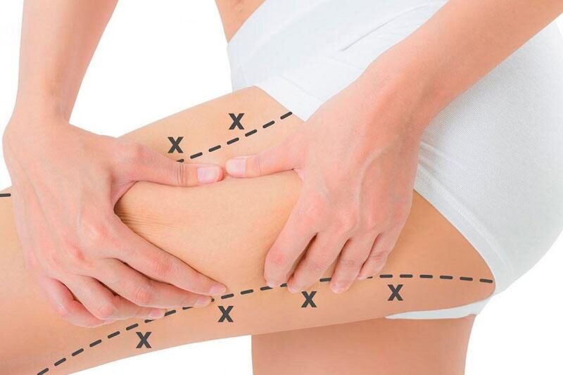 Феморопластика