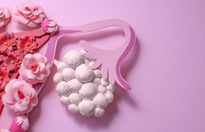Полікістоз яєчників: чому виникає і як його швидко вилікувати