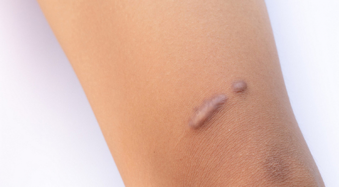 Келоїдні рубці: як позбутися їх назавжди