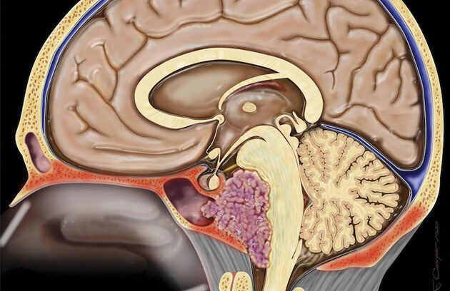 Назальная ликворея