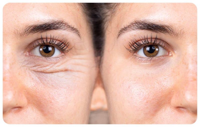 Блефаропластика