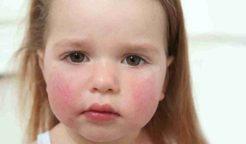 Основні прояви алергії у дітей та лікування
