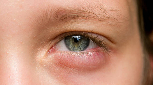 Аллергия или непереносимость продуктов